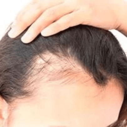 tratament impotriva alopeciei